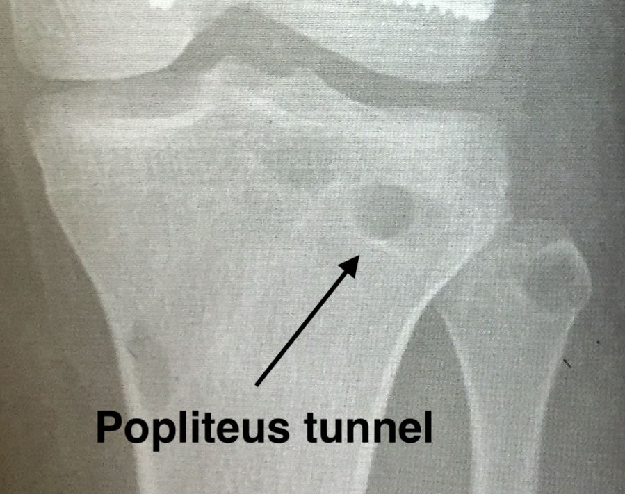 Popliteus tunnel 1